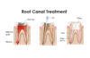 Root Canal Treatment: Information You Need To Recognize