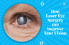 How Laser Eye Surgery can improve Your Vision