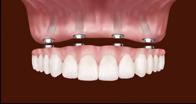 How To Clean All-On-4 Dental Implants?
