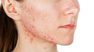 What does hyaluronic acid do for acne