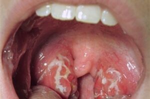 Why Do White Spots Appear On the Back of Your Throat