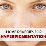 7 Natural Home Remedies to Reduce Skin Pigmentation