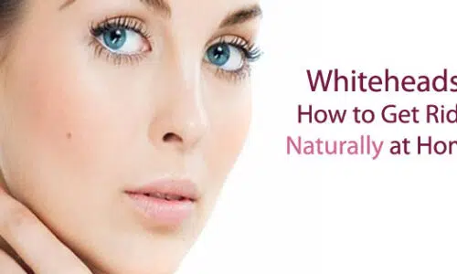 How to Remove Whiteheads Fast at Home (Natural Remedies)