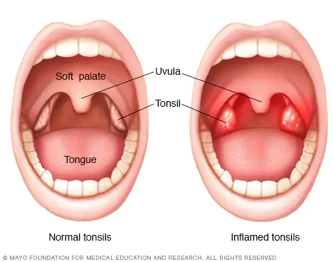 Why Do People Get Their Tonsils Removed