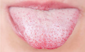 dehydration white tongue