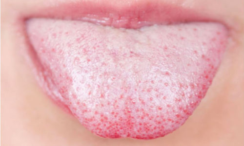 Dehydration and White Tongue – Causes, Symptoms and Treatment
