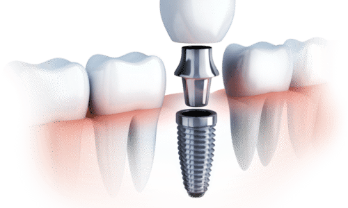Get the benefits of dental implants