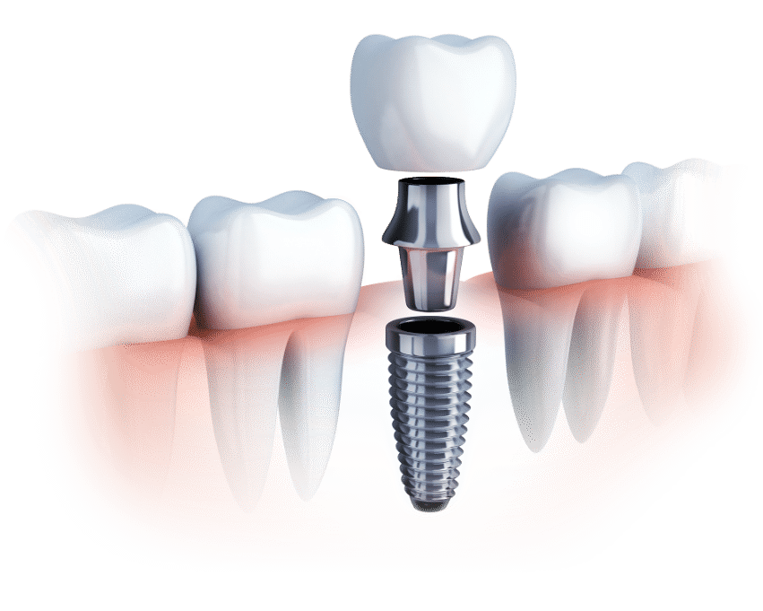 Get the benefits of dental implants