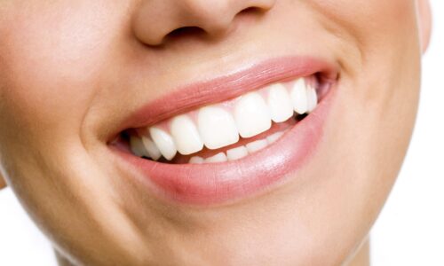 Is it worth it to get your teeth professionally whitened?