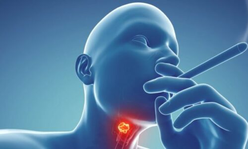 Introduction to Cobblestone Throat Treatment