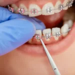 When Do You Get Power Chains on Braces: A Comprehensive Guide